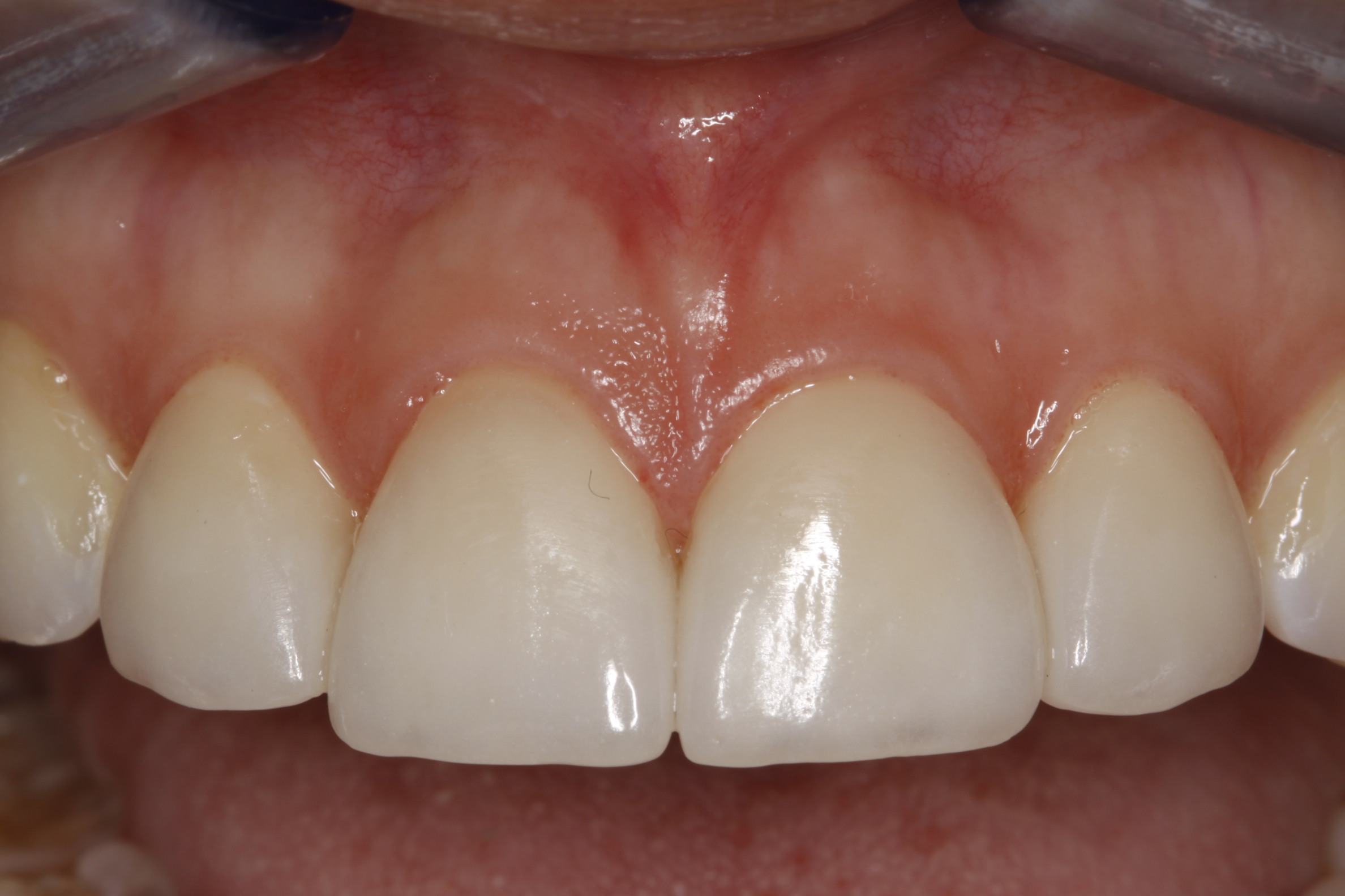 After - Porcelain Veneers