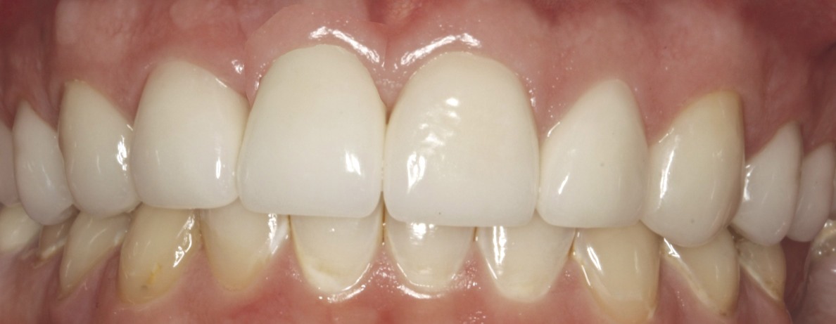 After - All Ceramic Implant and Crowns