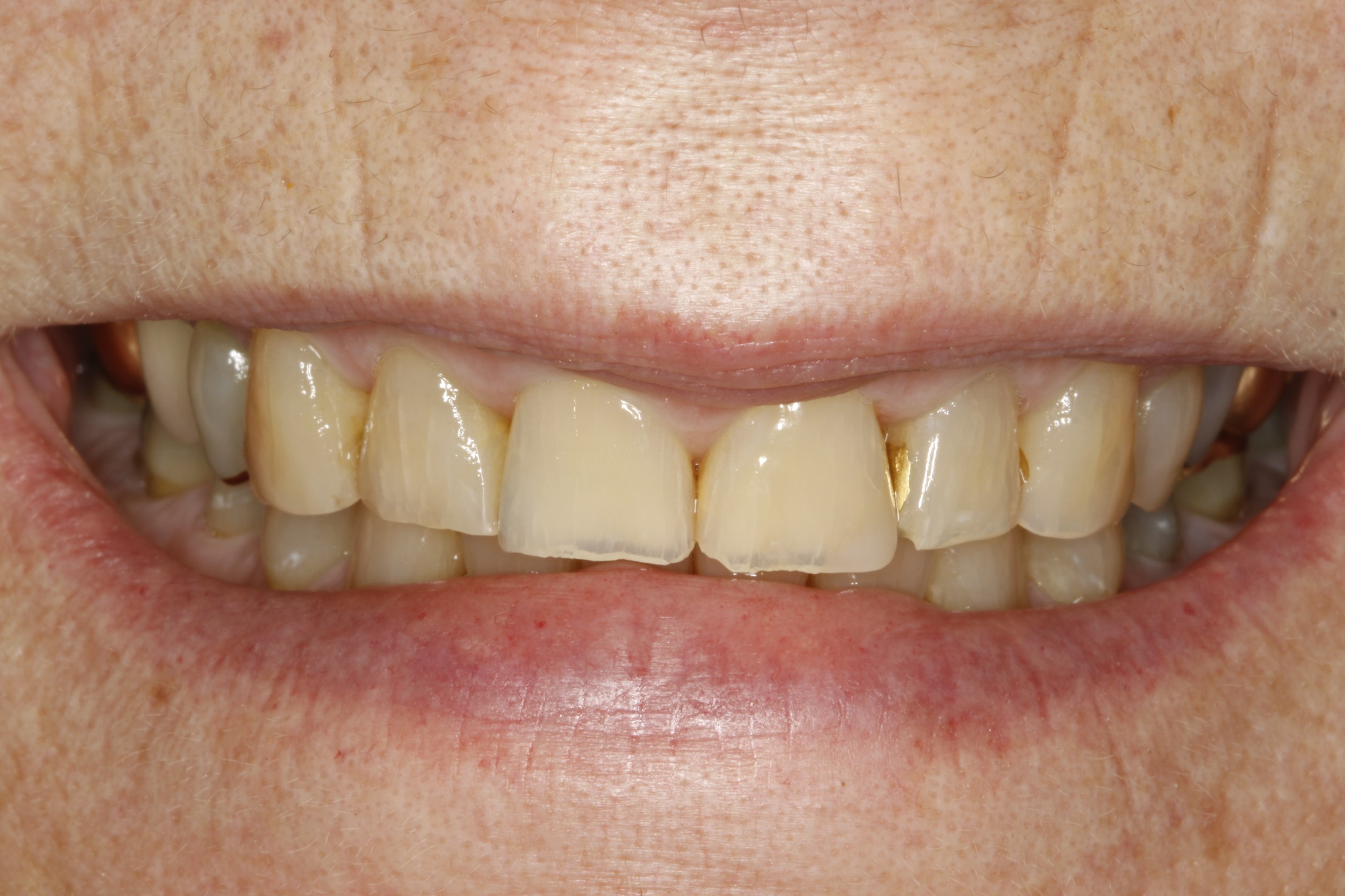 After 1 - All Ceramic Crowns
