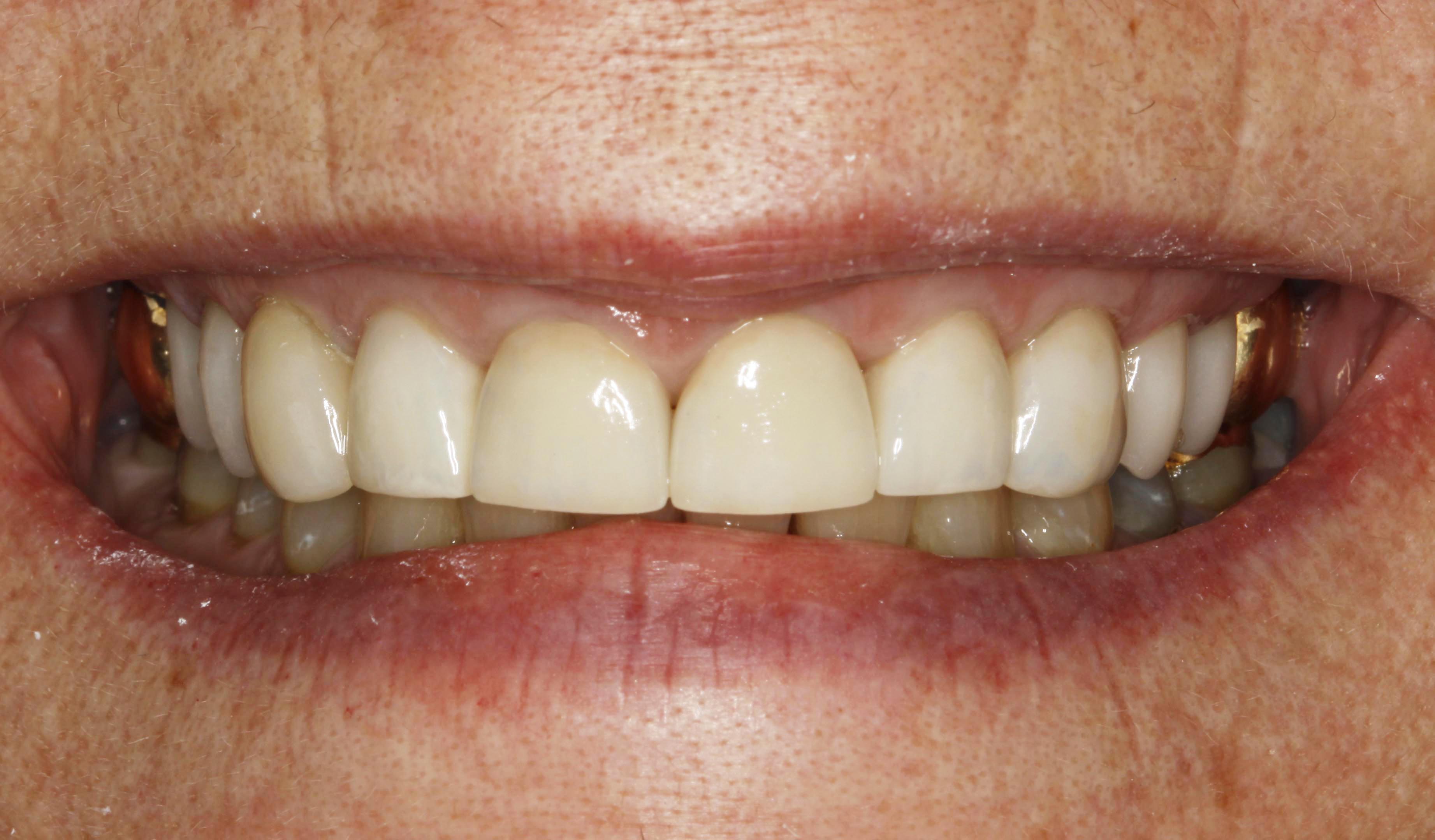 After 2 - All Ceramic Crowns