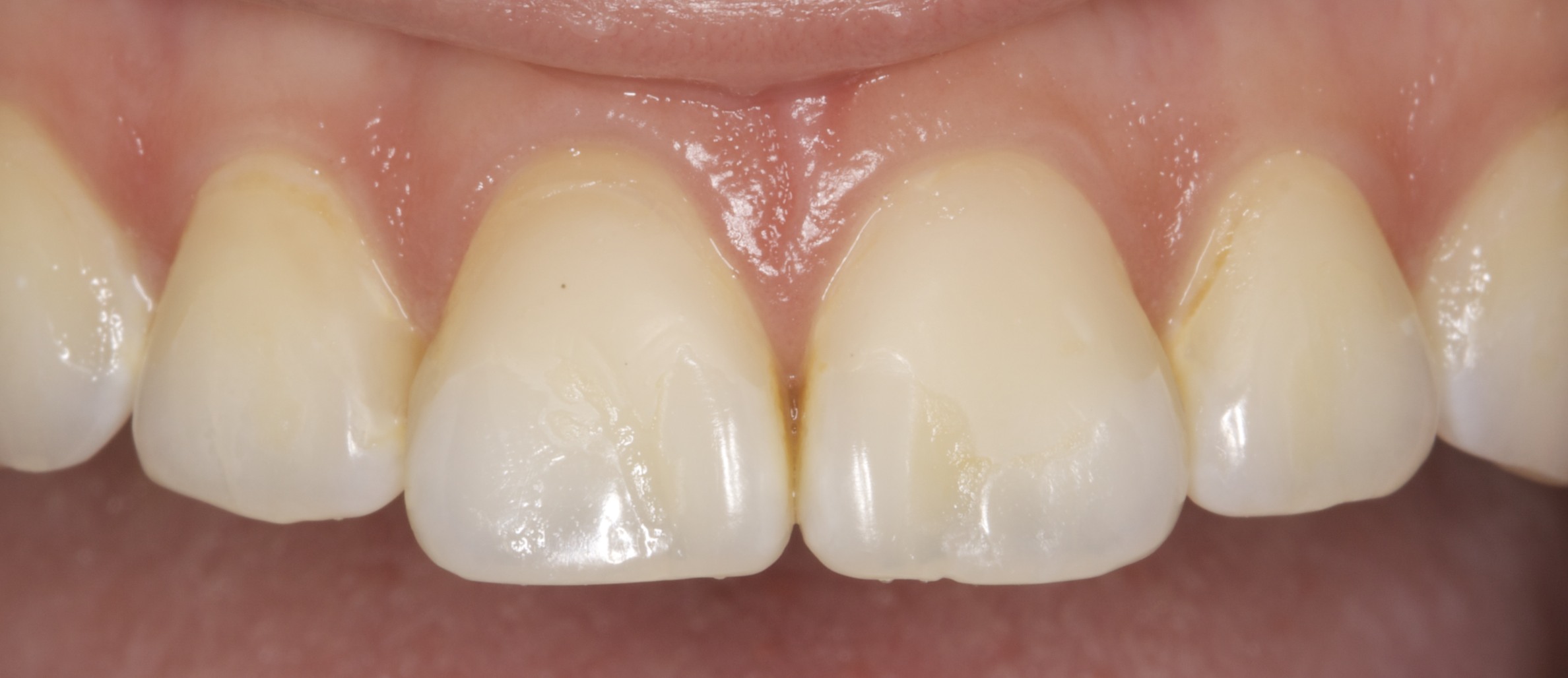 Before - Porcelain Veneers