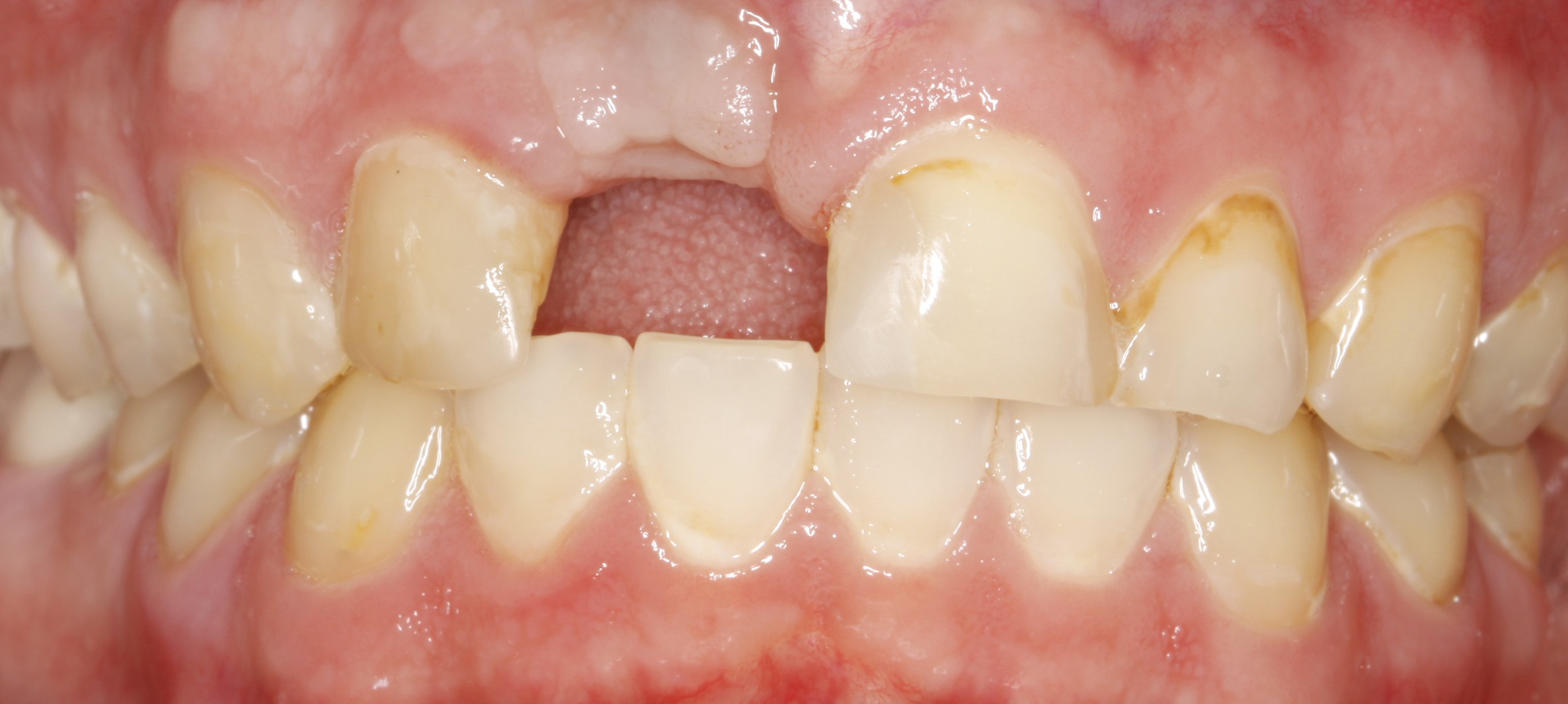 Before - All Ceramic Implant and Crowns